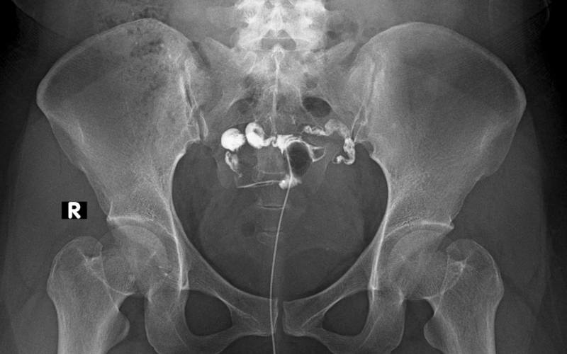 HSG (Histerosalpingografi)